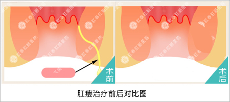 肛裂