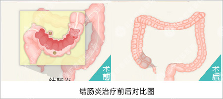 结肠炎