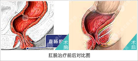 脱肛