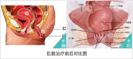 脱肛