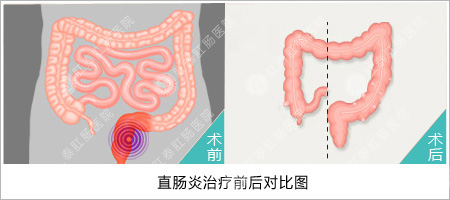 直肠炎