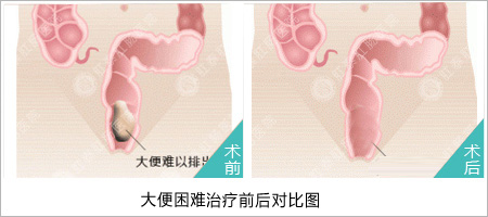 大便困难