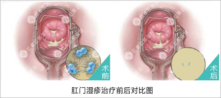 肛门湿疹