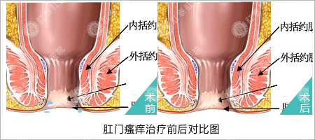 肛门瘙痒