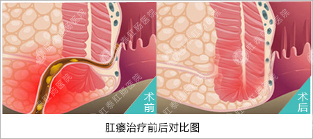 肛瘘