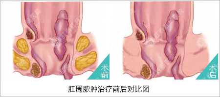 肛周脓肿