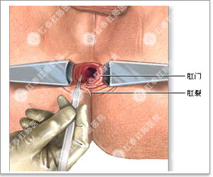 肛裂