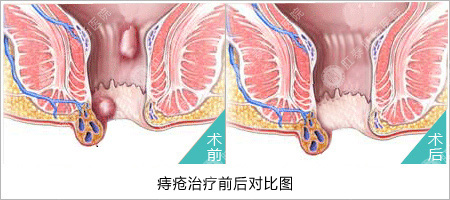 痔疮