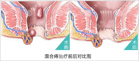 混合痔