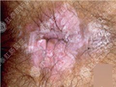 肛周湿疹