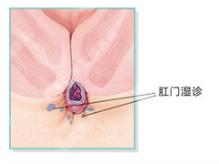 肛门湿疹治疗