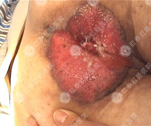 肛门湿疹的症状