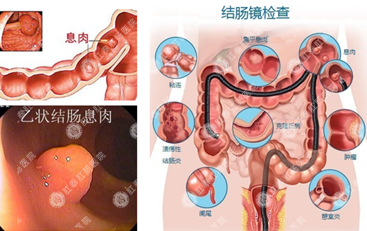 南宁肠道息肉怎么发现和治疗